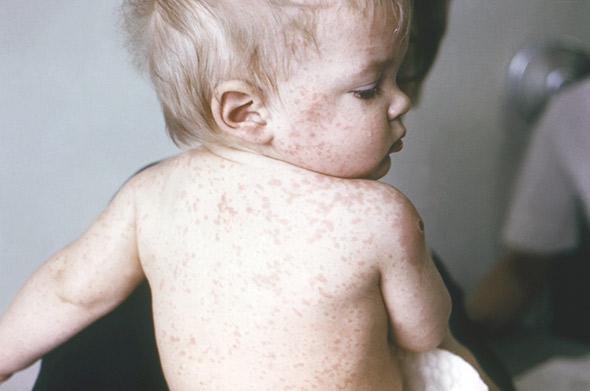 A young child suffers from measles in the 1960s.